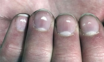 Manchas blancas en las uñas: causas y remedios.