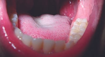 Úlcera bucal que es y como tratarla