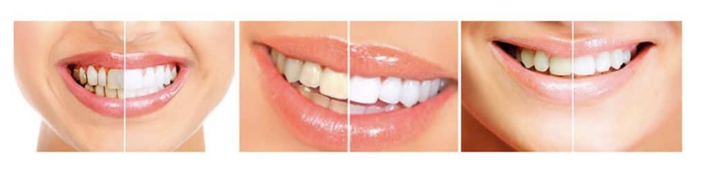 Prima E Dopo Dental White Stripes